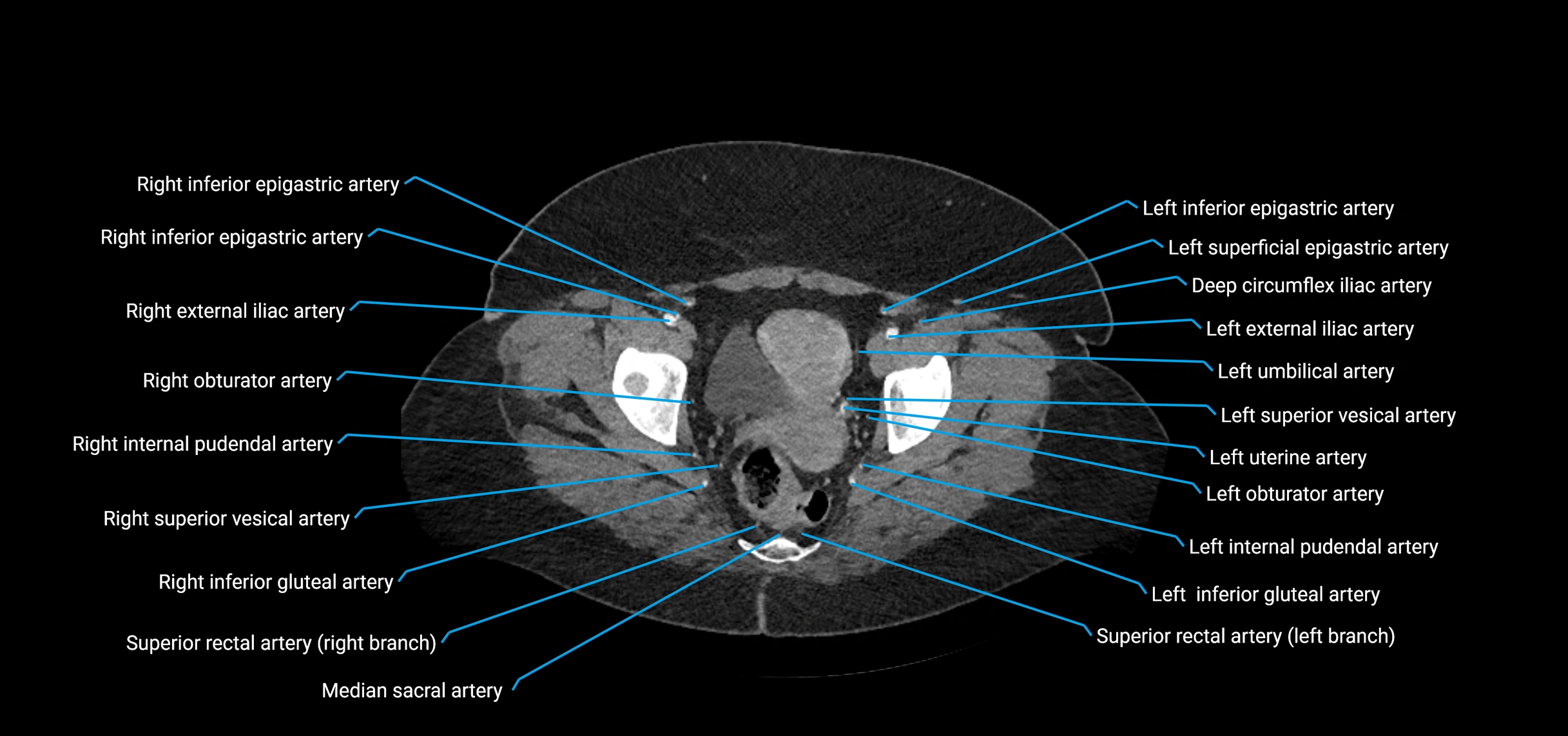 CTA abdomen axial cross sectional anatomy labelled image_232 (2).webp